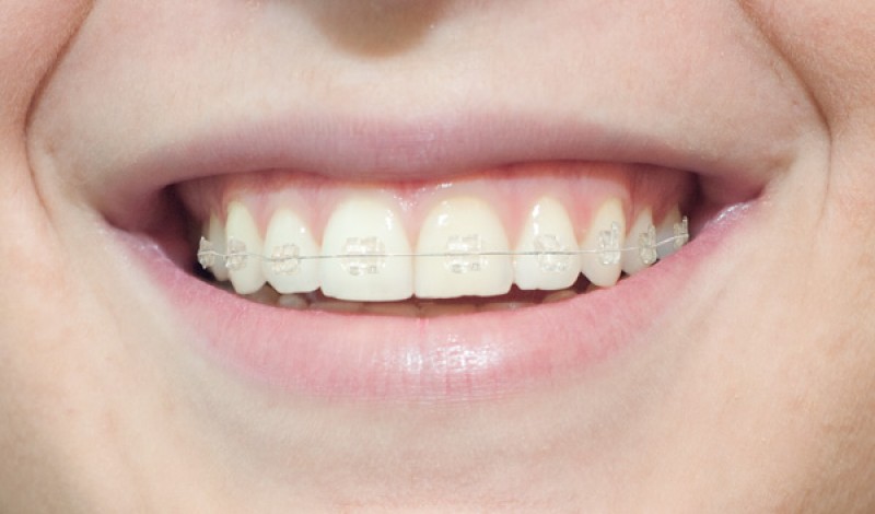 Resultado de imagen de ortodoncia estetica